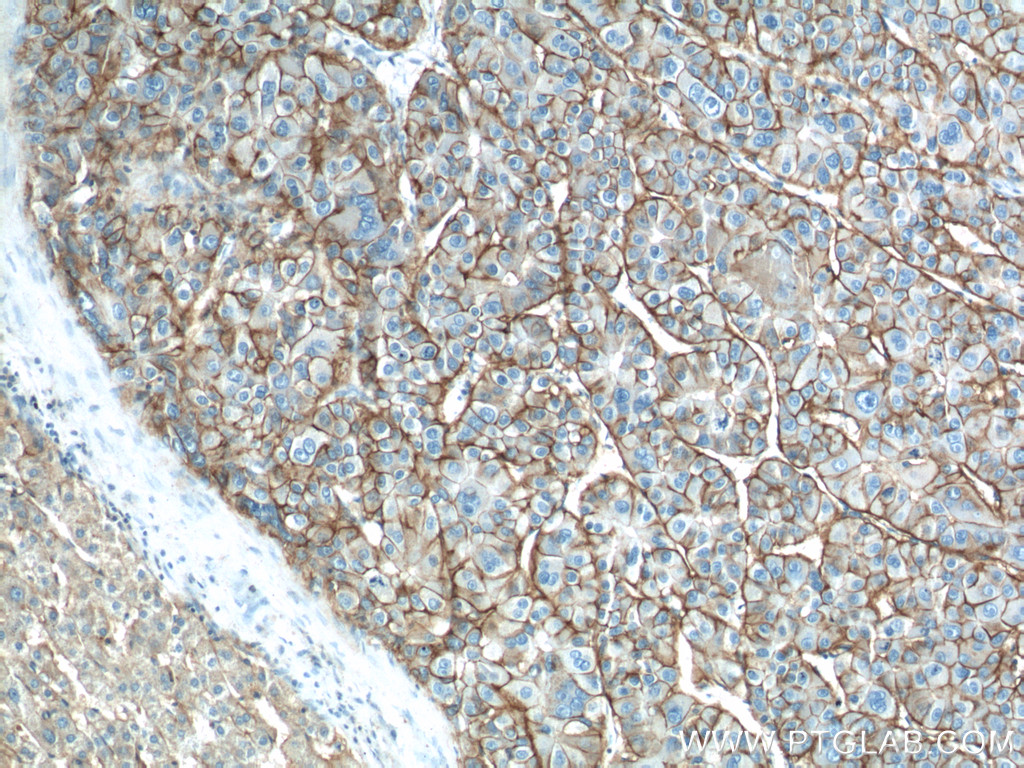 IHC staining of human liver cancer using 14418-1-AP
