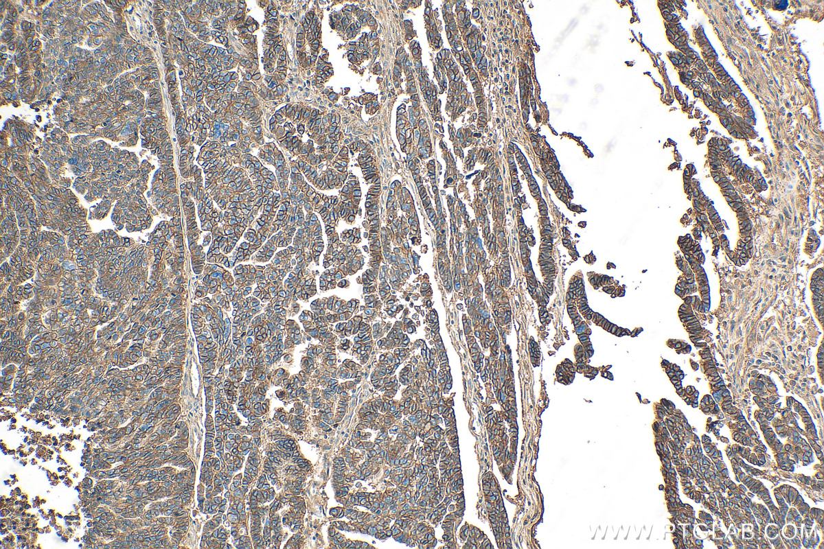 IHC staining of human ovary tumor using 14418-1-AP