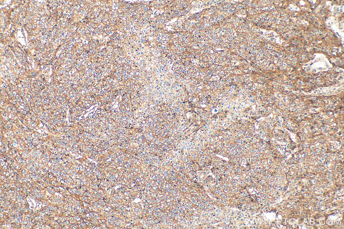 Immunohistochemical analysis of paraffin-embedded human cervical cancer tissue slide using 14418-1-AP (ATP1A1 antibody) at dilution of 1:4000 (under 10x lens). Heat mediated antigen retrieval with Tris-EDTA buffer (pH 9.0). IHC staining of human cervical cancer using 14418-1-AP