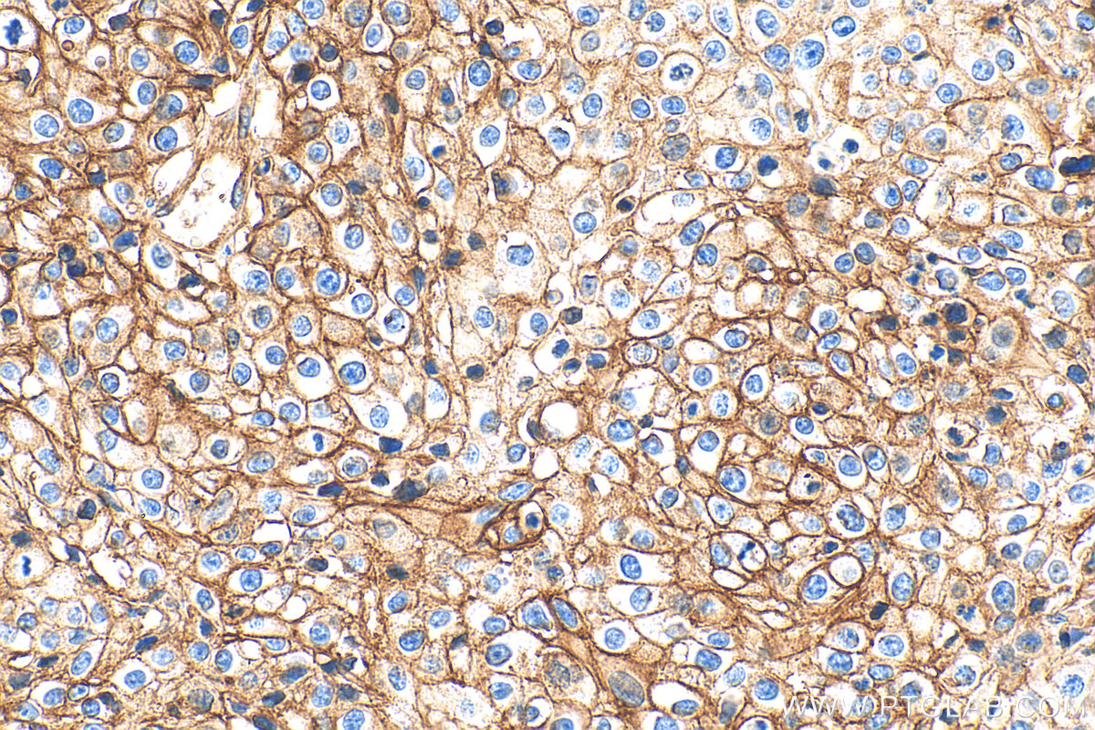 Immunohistochemical analysis of paraffin-embedded human cervical cancer tissue slide using 14418-1-AP (ATP1A1 antibody) at dilution of 1:4000 (under 40x lens). Heat mediated antigen retrieval with Tris-EDTA buffer (pH 9.0). IHC staining of human cervical cancer using 14418-1-AP