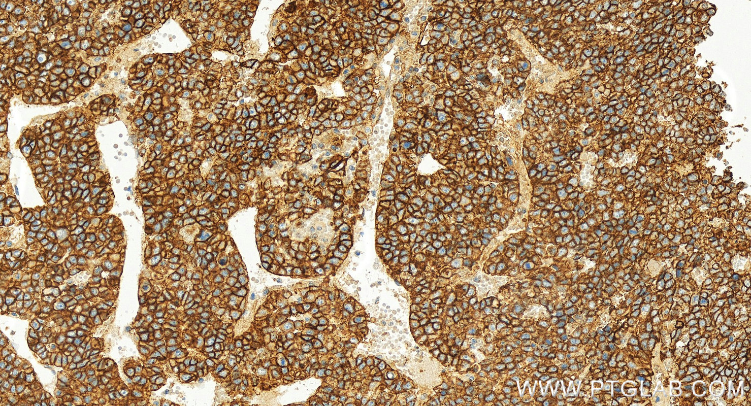 IHC staining of human hepatocellular ca using 55187-1-AP