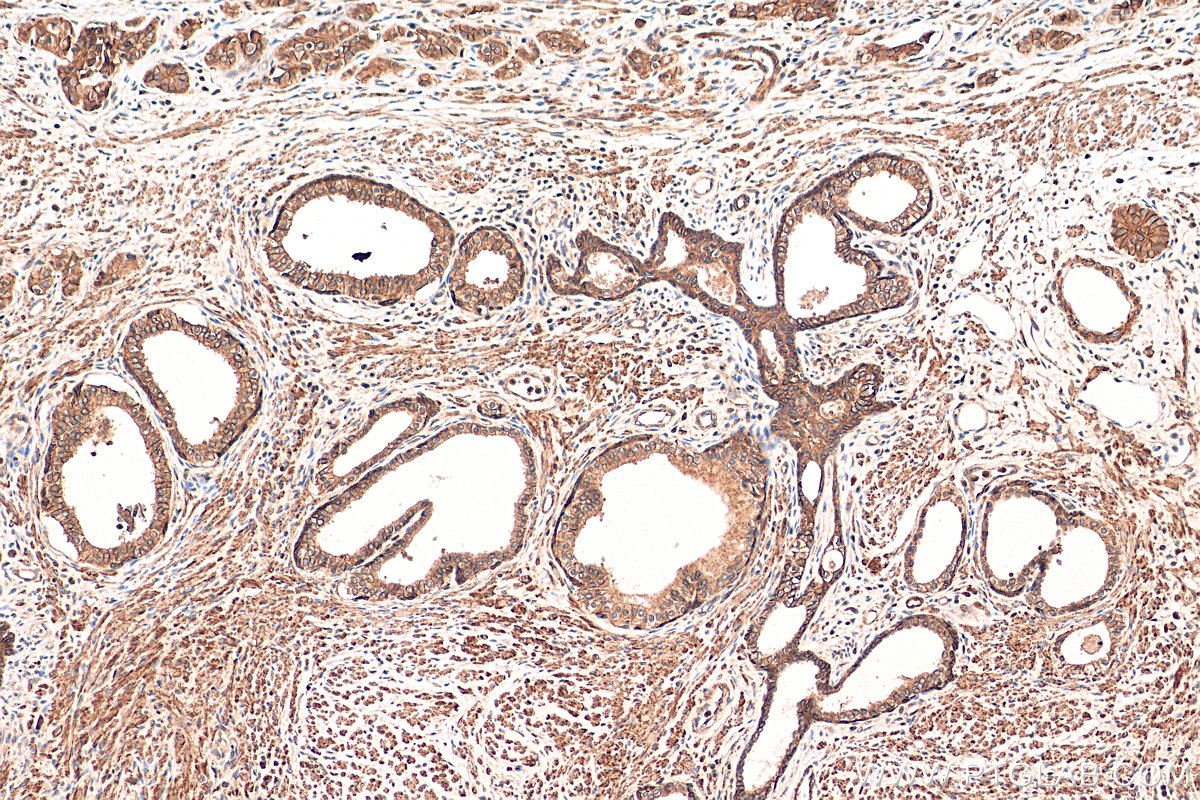 IHC staining of human prostate cancer using 10868-1-AP