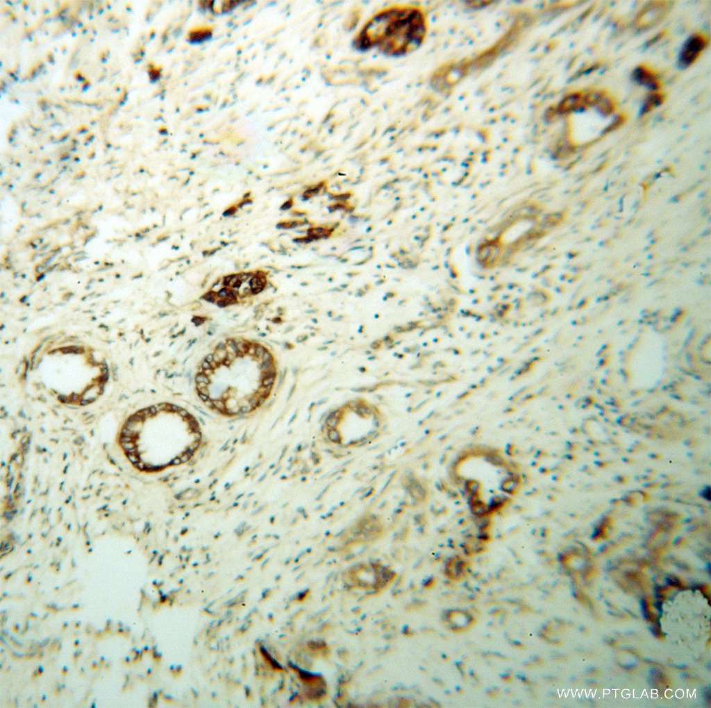 IHC staining of human pancreas cancer using 13619-1-AP