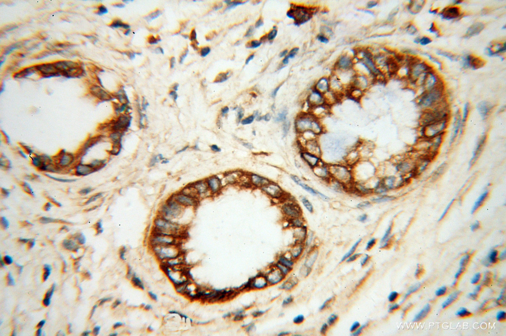 IHC staining of human pancreas cancer using 13619-1-AP