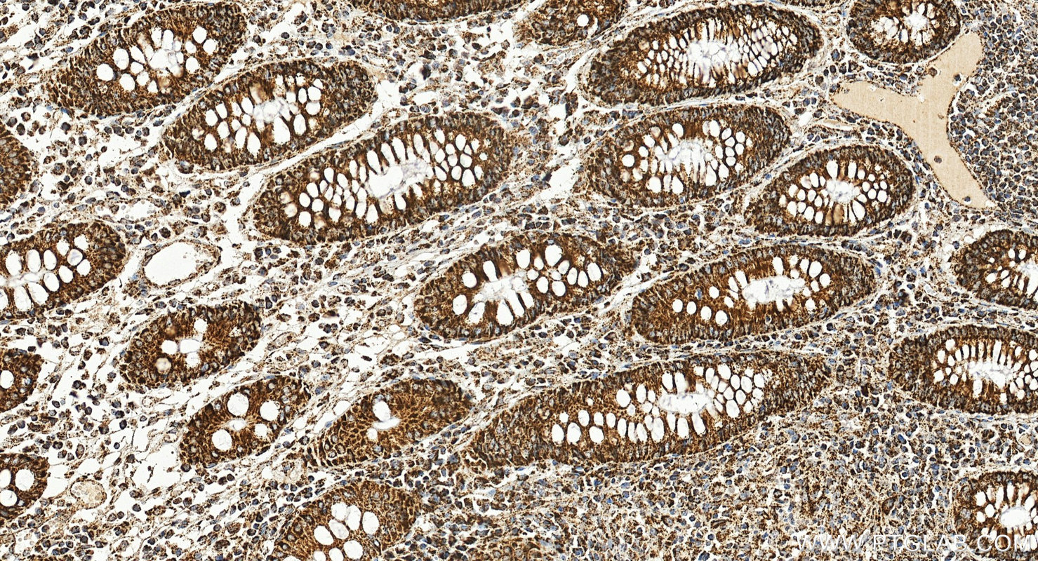 IHC staining of human colon cancer using 66037-1-Ig