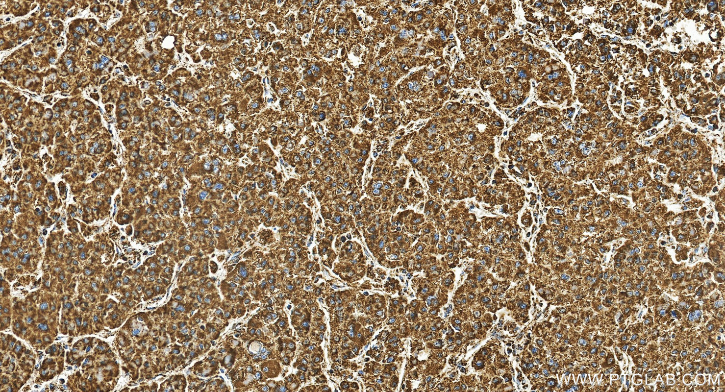 IHC staining of Hepatocellular carcinoma using 66037-1-Ig