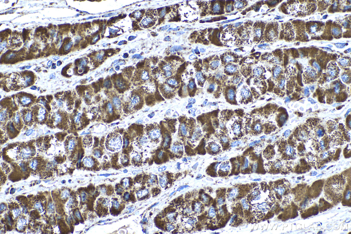IHC staining of human liver cancer using 66037-1-Ig (same clone as 66037-1-PBS)