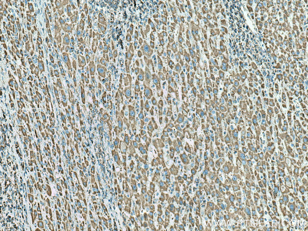 IHC staining of human liver cancer using 10910-1-AP