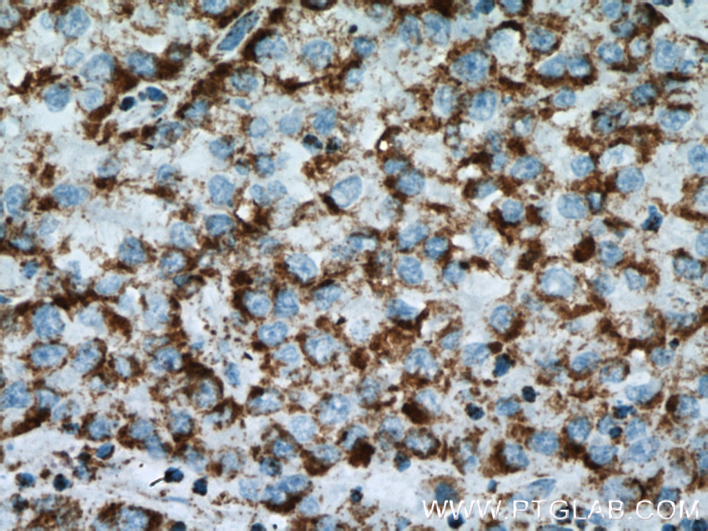 IHC staining of human liver cancer using 60284-1-Ig