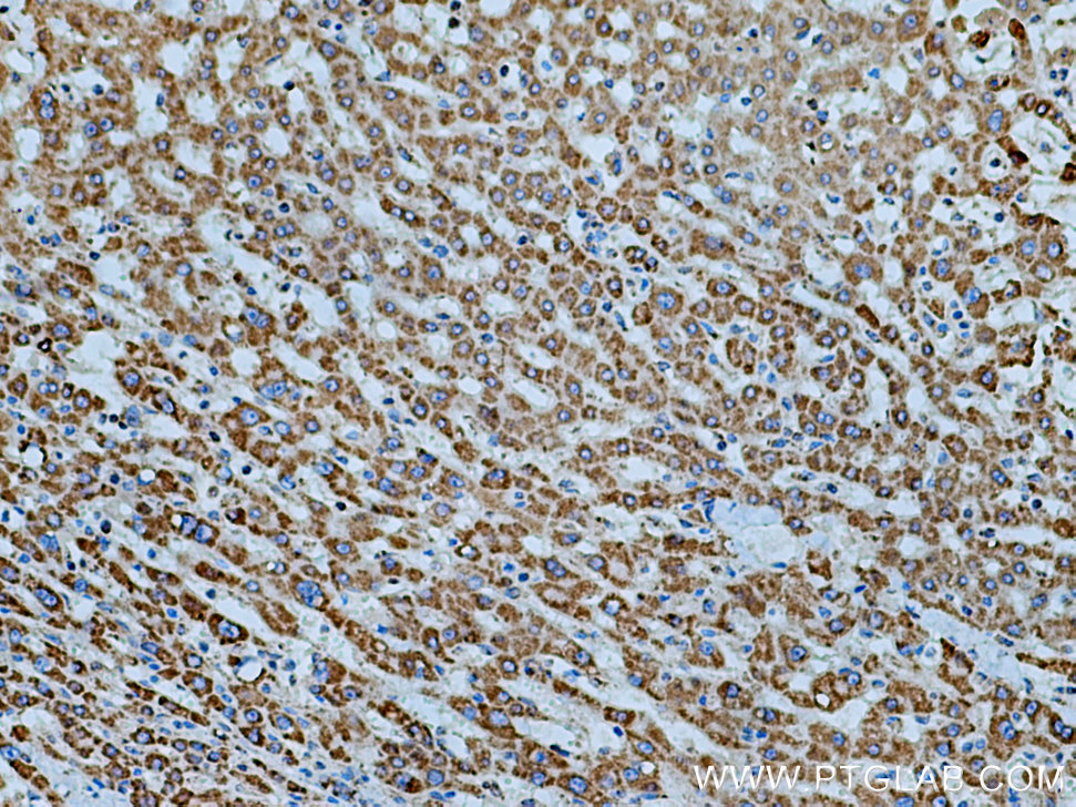 IHC staining of human liver cancer using 14893-1-AP