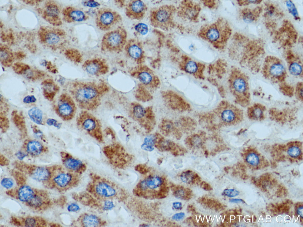 IHC staining of human liver cancer using 14893-1-AP