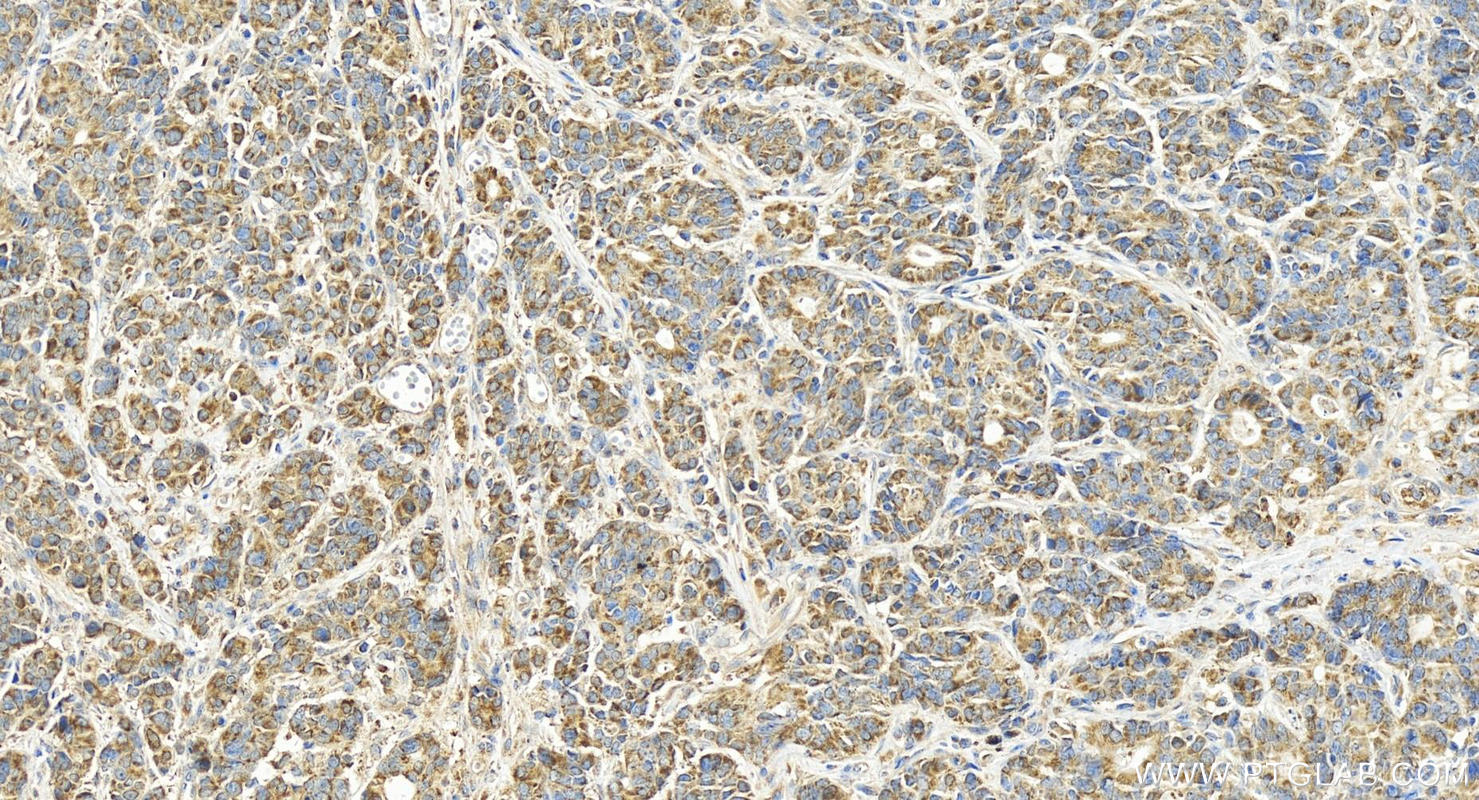 Immunohistochemical analysis of paraffin-embedded human stomach cancer tissue slide using 16307-1-AP (ATP5L antibody) at dilution of 1:400 (under 20x lens). Heat mediated antigen retrieval with Tris-EDTA buffer (pH 9.0). IHC staining of human stomach cancer using 16307-1-AP