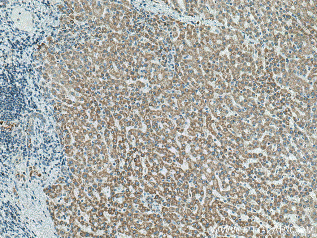 IHC staining of human liver cancer using 66696-1-Ig