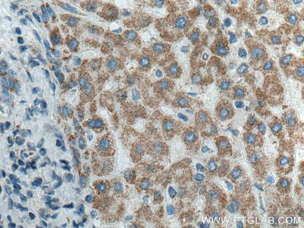 IHC staining of human liver cancer using 66696-1-Ig