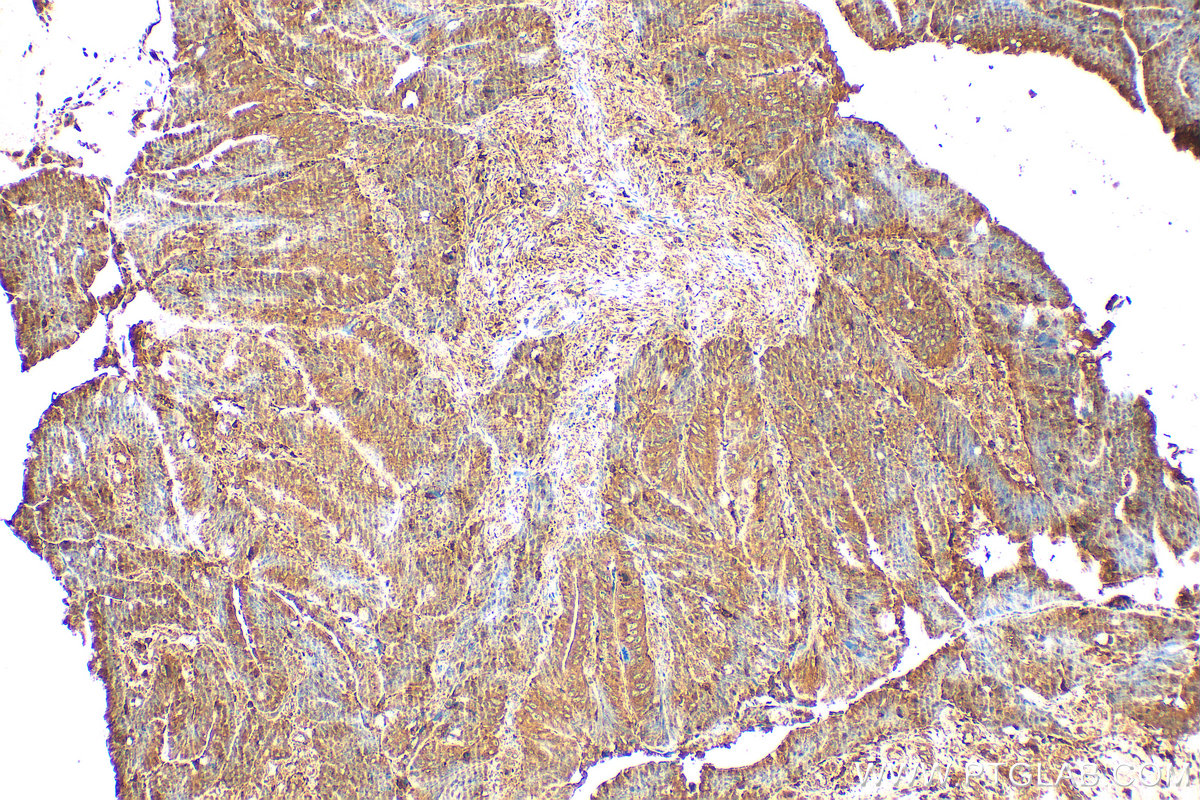 IHC staining of human colon cancer using 15097-1-AP