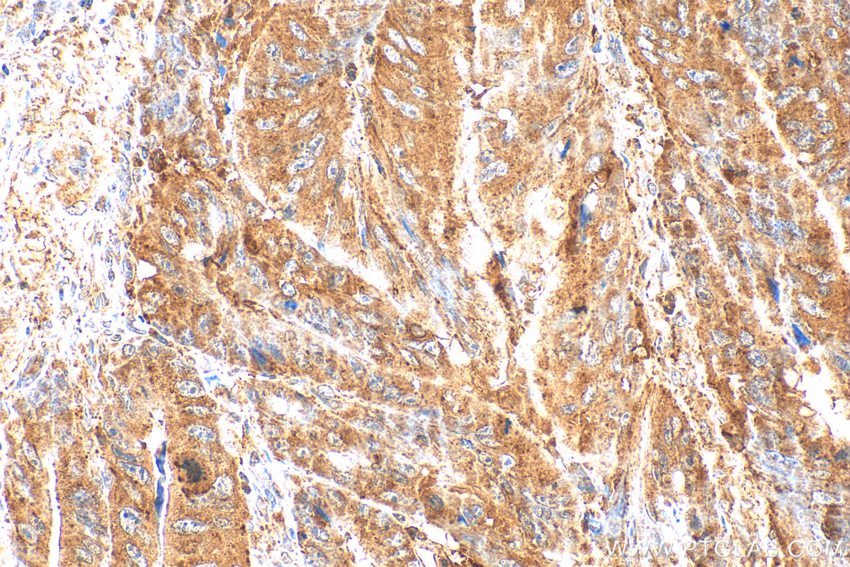 IHC staining of human colon cancer using 15097-1-AP