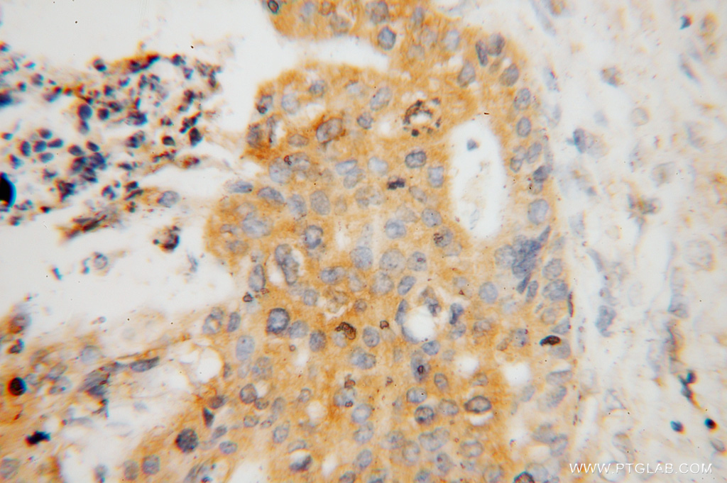 IHC staining of human stomach cancer using 16054-1-AP