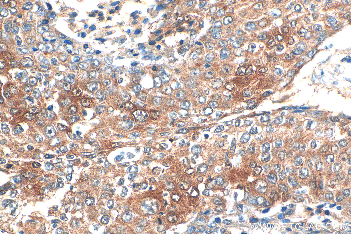 IHC staining of human lung cancer using 55375-1-AP