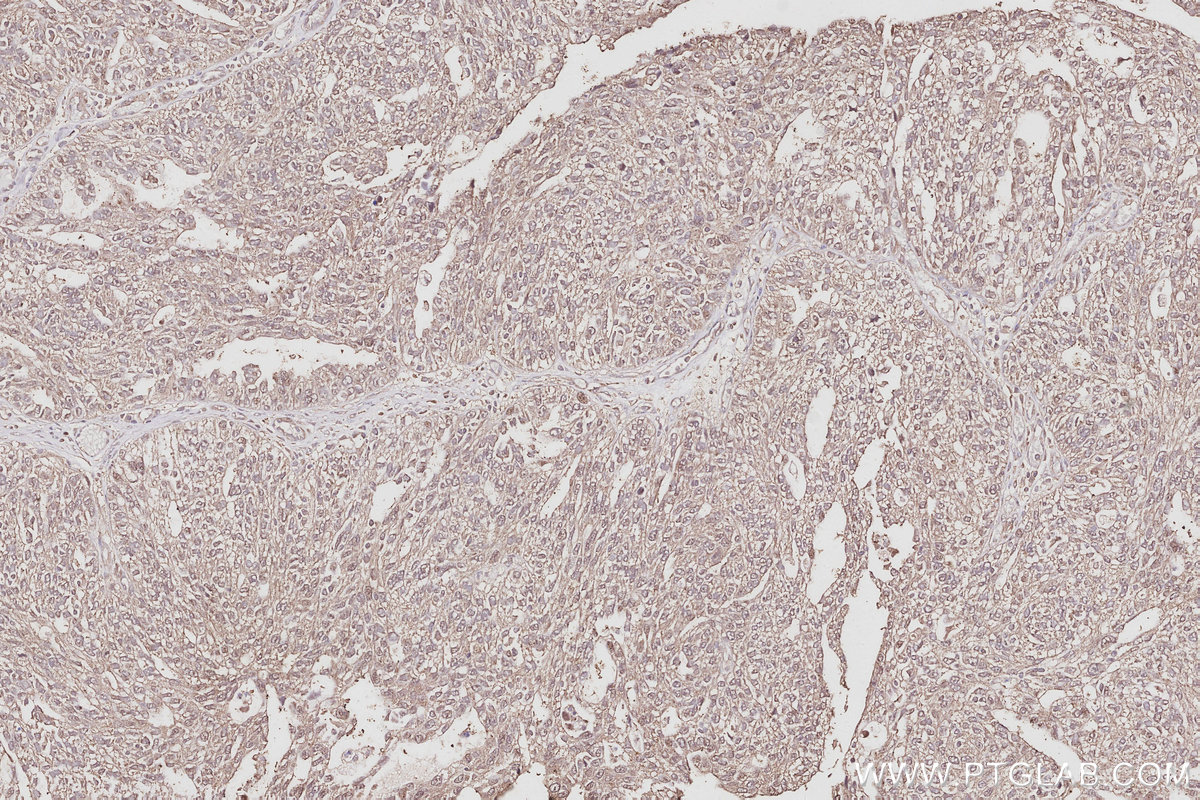 IHC staining of human ovary cancer using 21565-1-AP IHC staining of human ovary cancer using 21565-1-AP