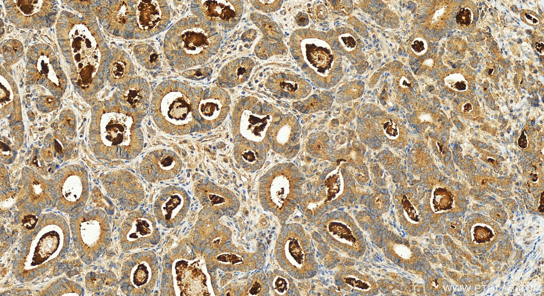 IHC staining of human stomach cancer using 15797-1-AP