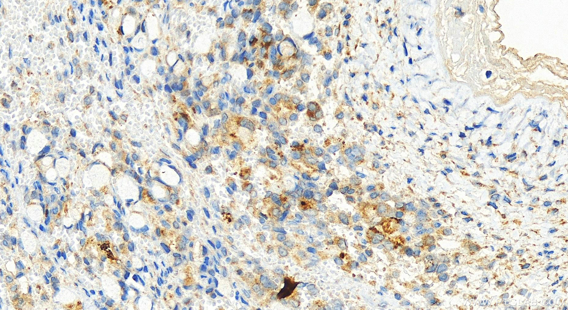 IHC staining of human ovary cancer using 15797-1-AP