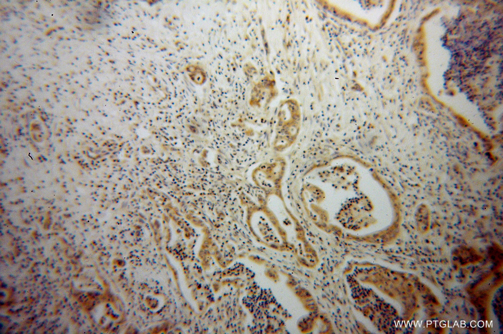 IHC staining of human pancreas cancer using 13505-1-AP