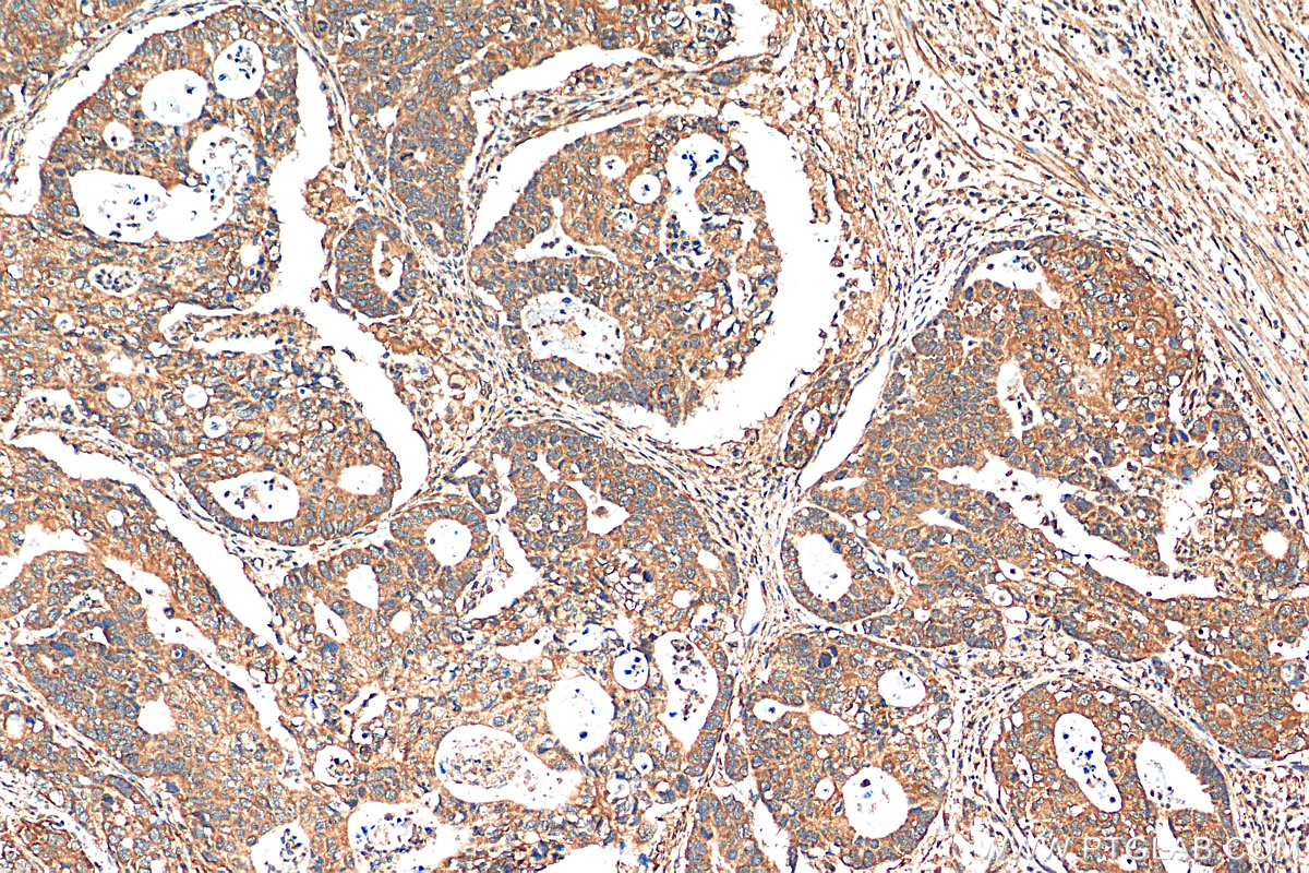 IHC staining of human stomach cancer using 24822-1-AP