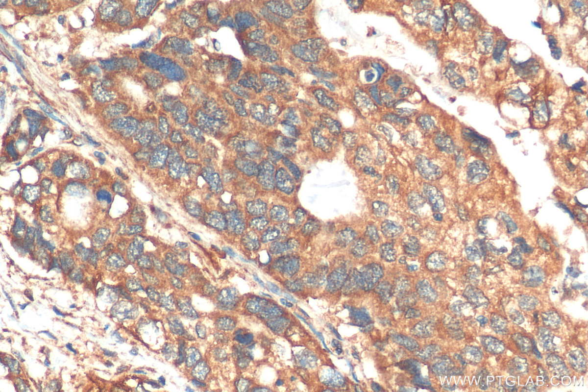 IHC staining of human stomach cancer using 24822-1-AP