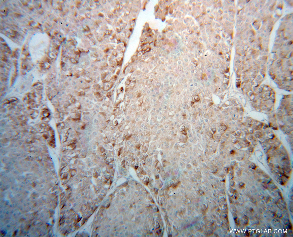 IHC staining of human liver cancer using 13726-1-AP