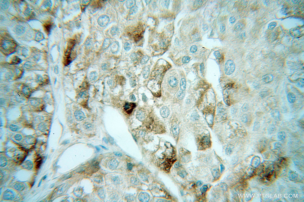 IHC staining of human liver cancer using 13726-1-AP