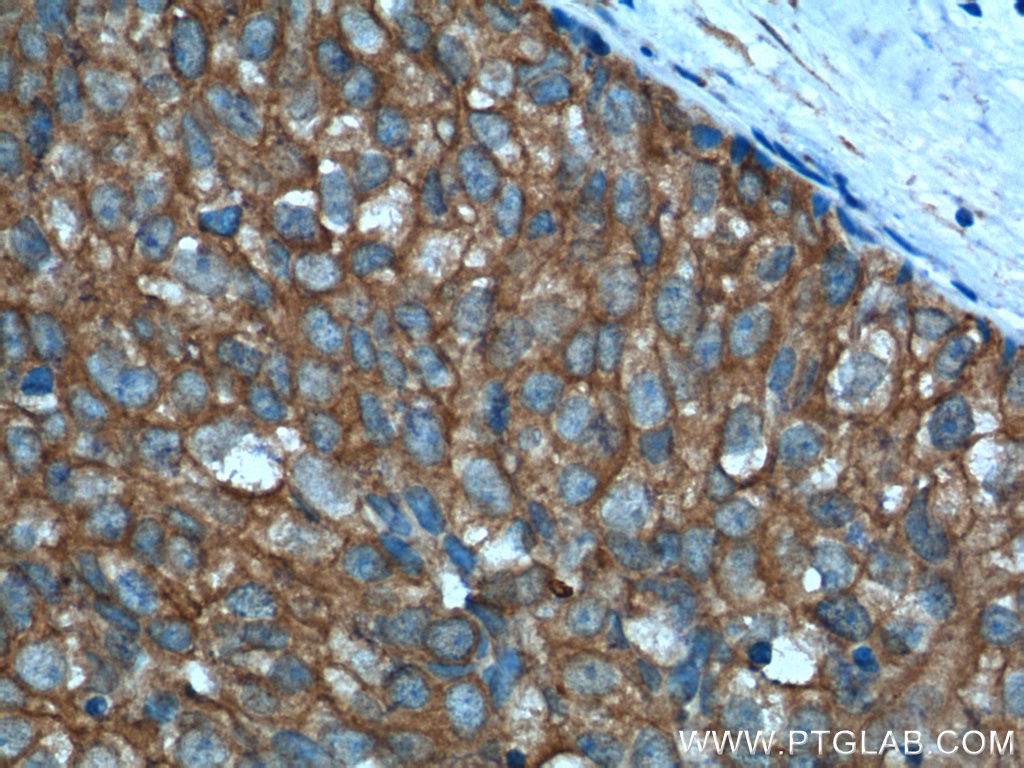 IHC staining of human breast cancer using 10297-1-AP