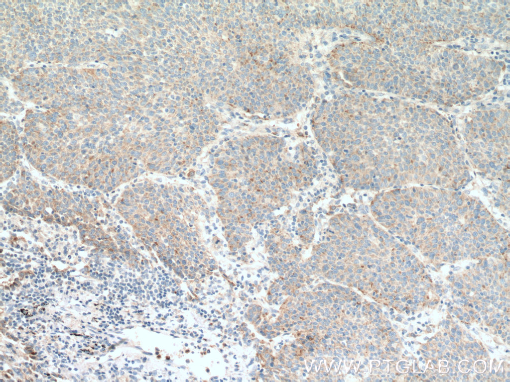 IHC staining of human lung cancer using 12005-1-AP (same clone as 12005-1-PBS)