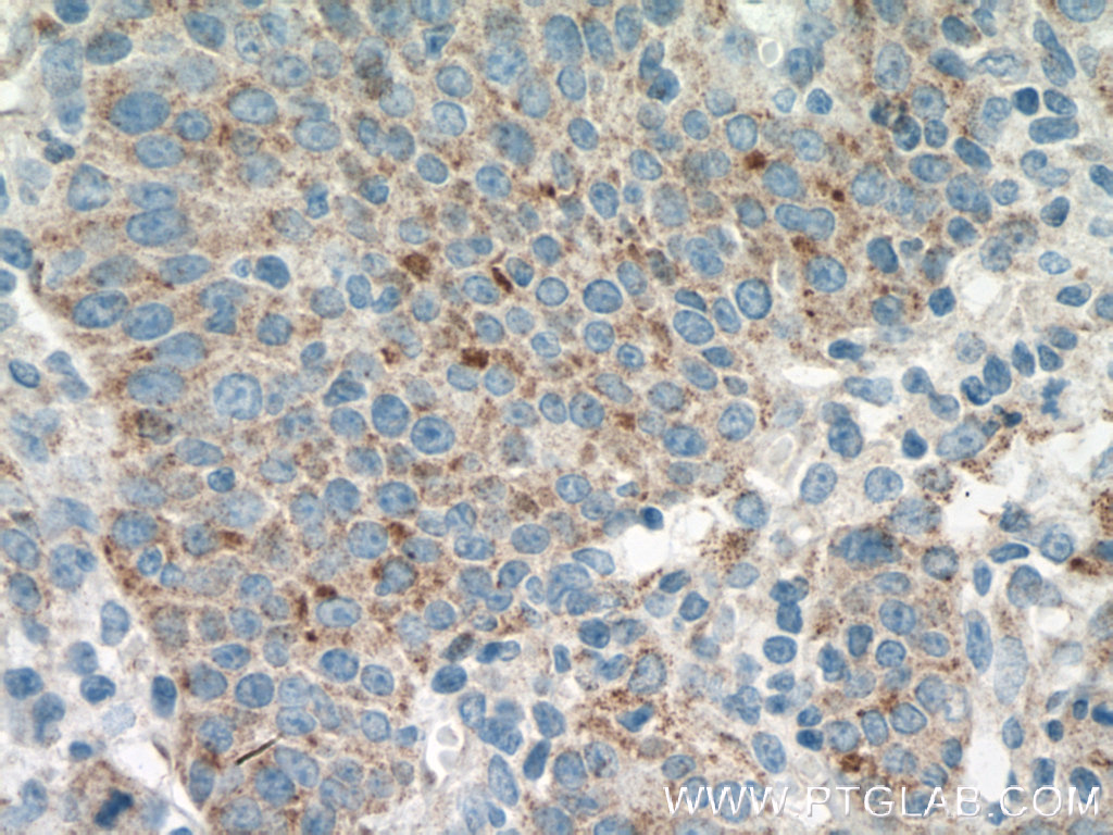 IHC staining of human lung cancer using 12005-1-AP (same clone as 12005-1-PBS)