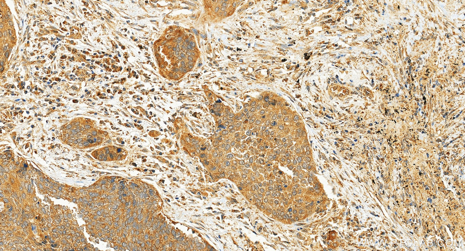 IHC staining of human lung cancer using 12005-1-AP