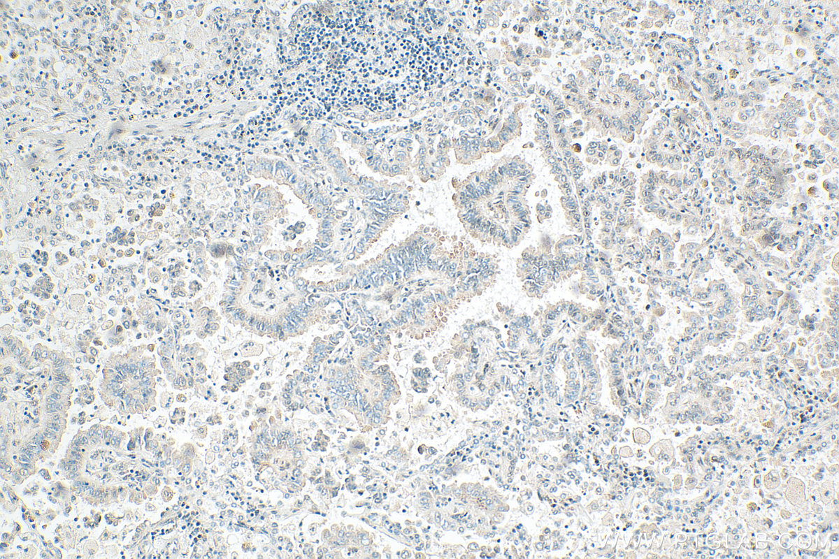 IHC staining of human lung cancer using 30532-1-AP