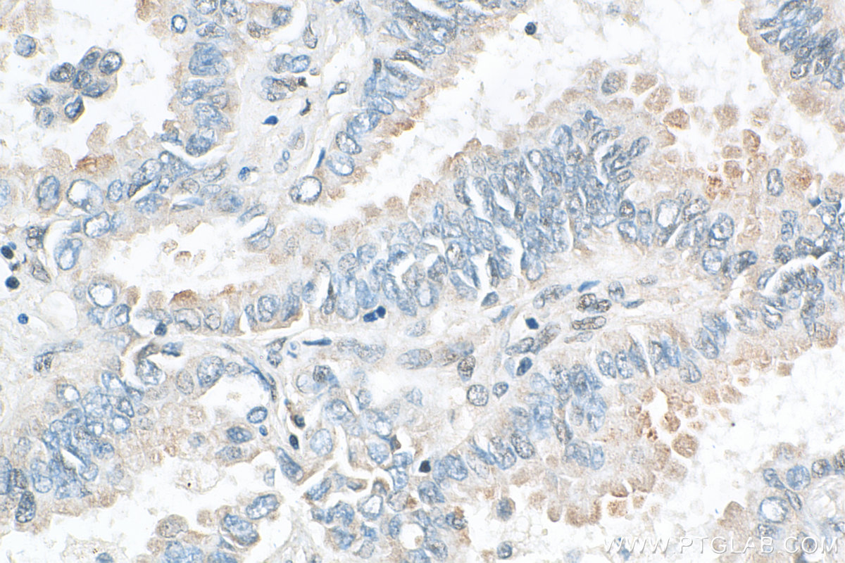 IHC staining of human lung cancer using 30532-1-AP