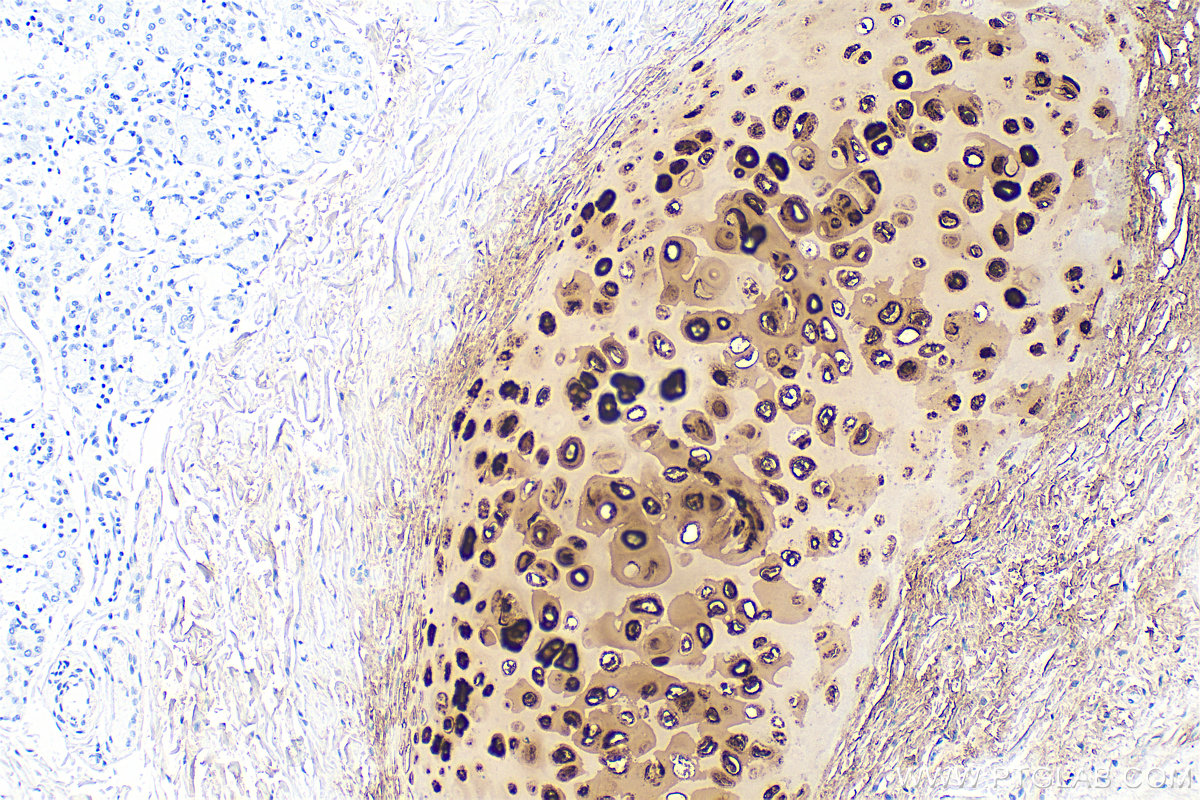 IHC staining of human lung cancer using 84819-5-RR (same clone as 84819-5-PBS)