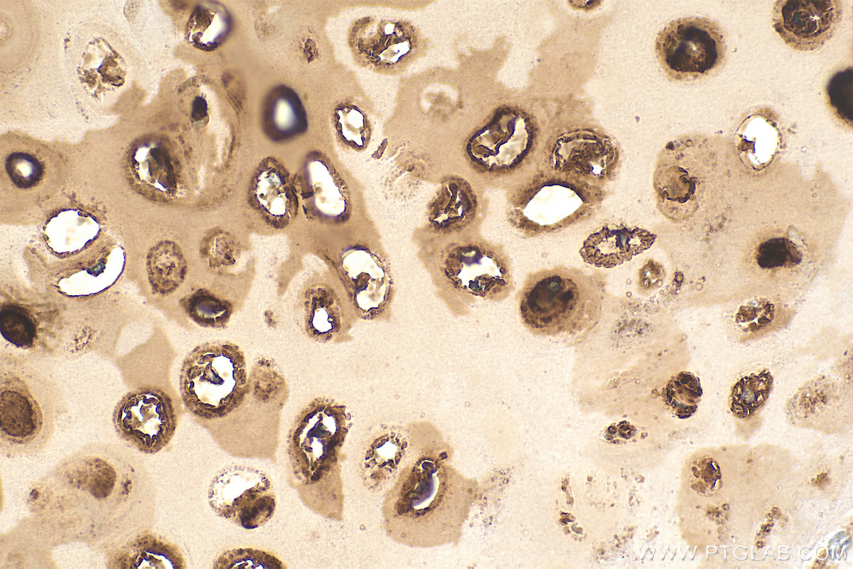 IHC staining of human lung cancer using 84819-5-RR (same clone as 84819-5-PBS)