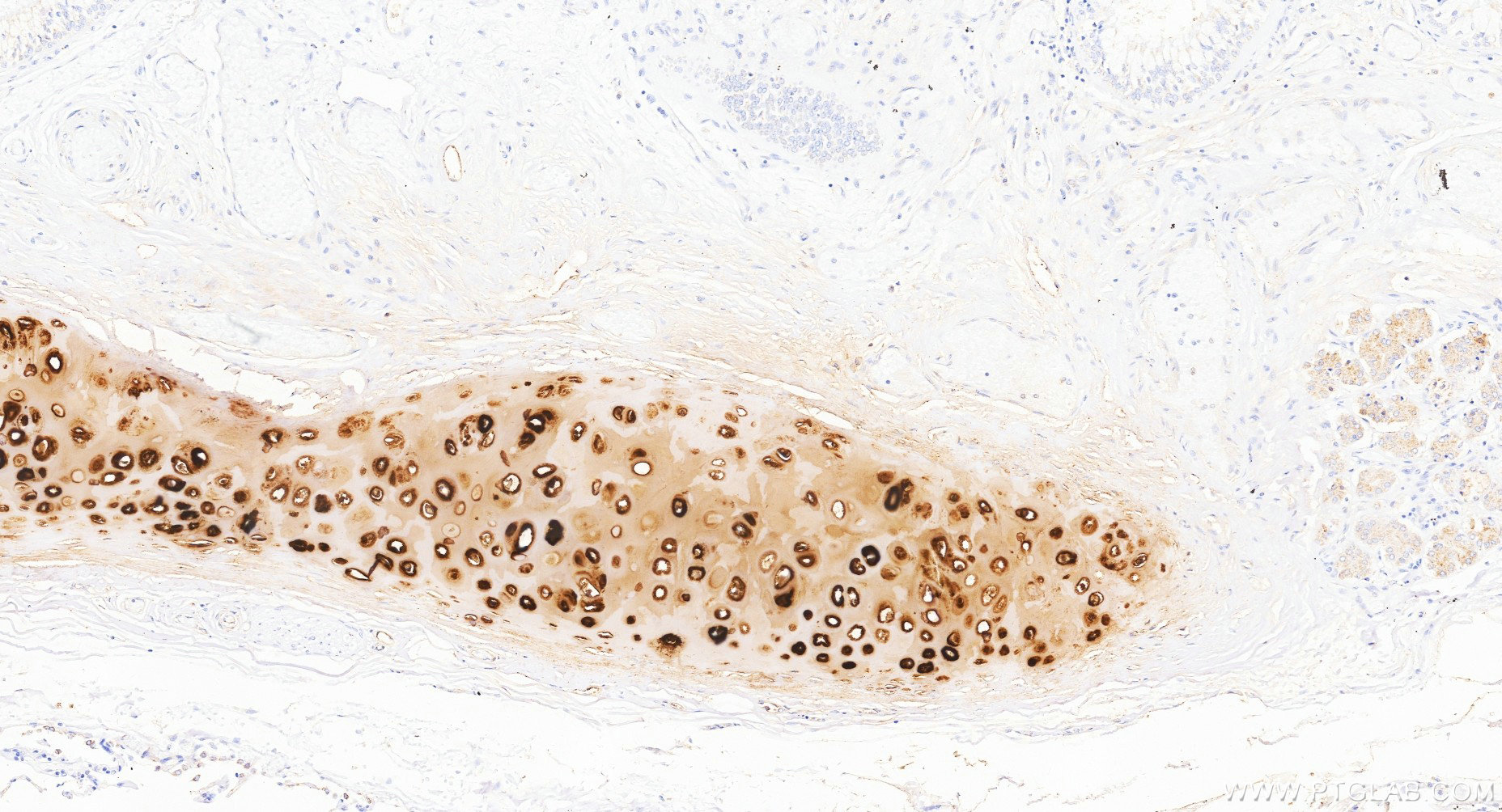 IHC staining of human lung cancer using Biotin-84819-5