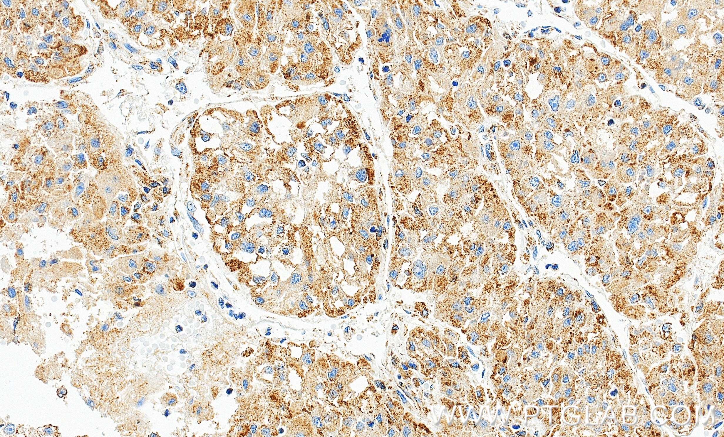 IHC staining of human liver cancer using 86472-3-RR IHC staining of human liver cancer using 86472-3-RR
