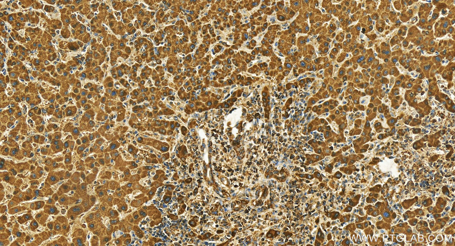 IHC staining of human intrahepatic cholangiocarcinoma using 26716-1-AP