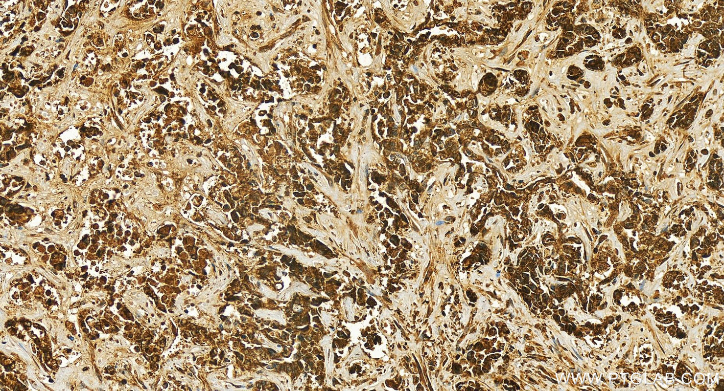 IHC staining of human intrahepatic cholangiocarcinoma using 26716-1-AP
