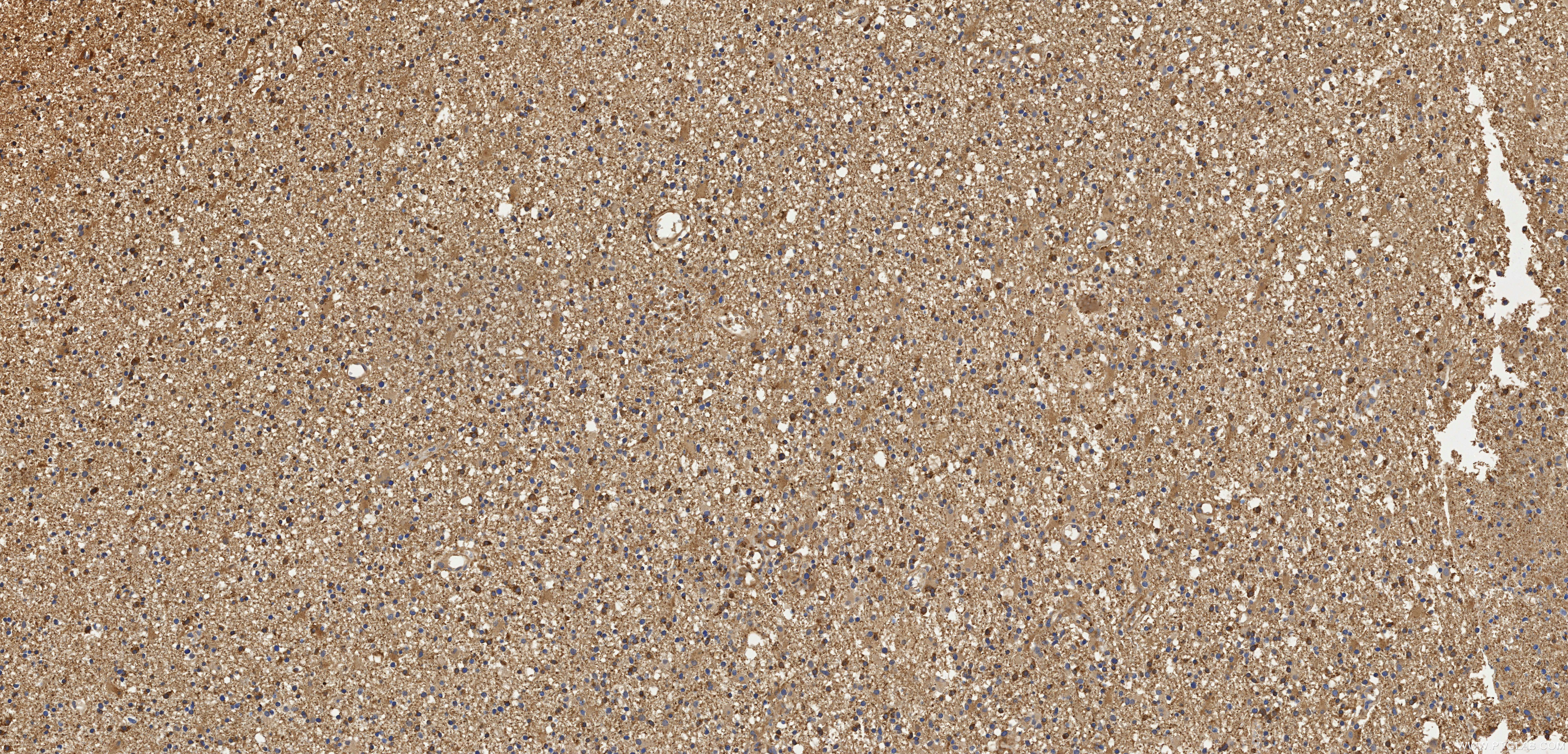 IHC staining of Human brain cancer（Astrocitoma） using 98708-2-RR