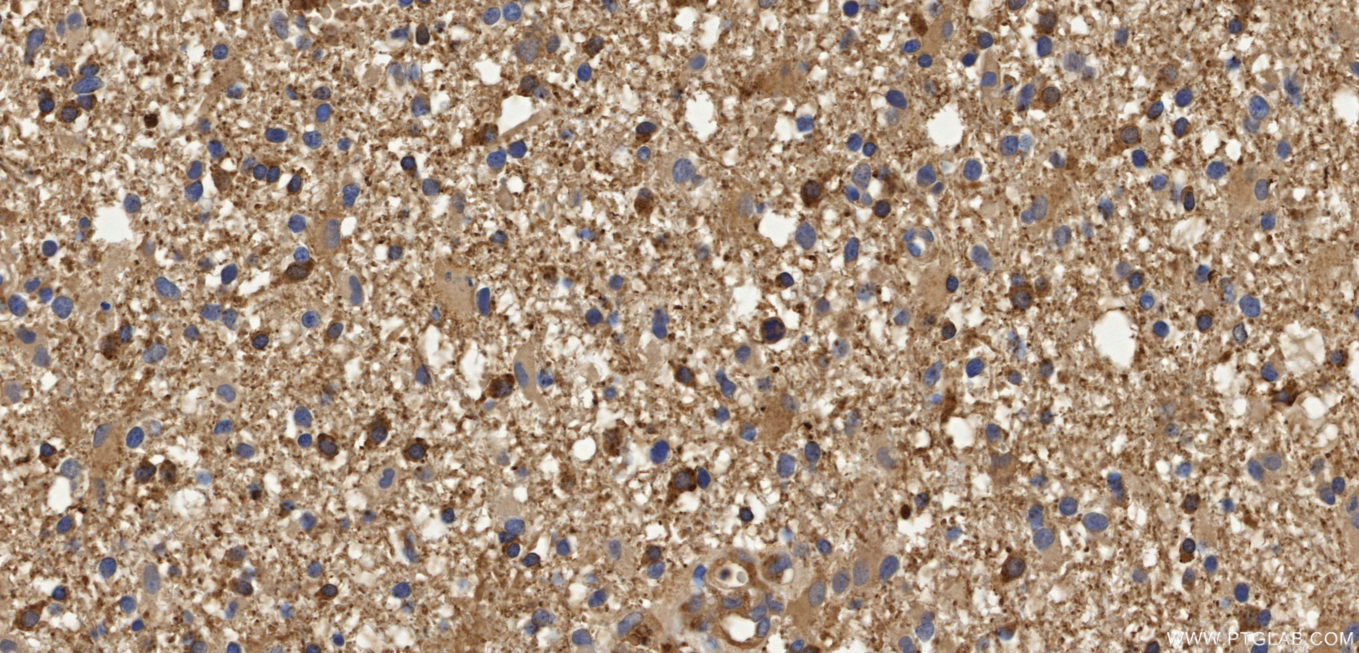 IHC staining of Human brain cancer（Astrocitoma） using 98708-2-RR
