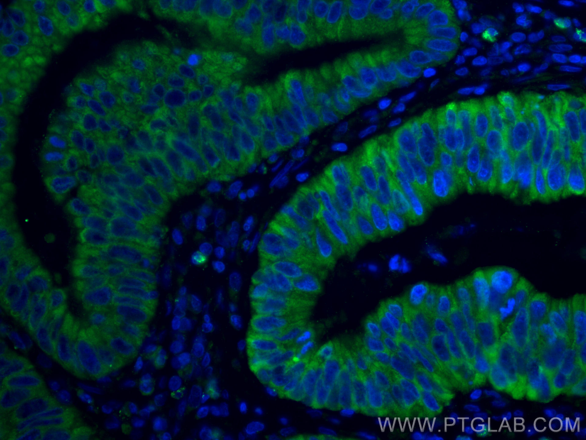 IF Staining of human colon cancer using CL488-16036