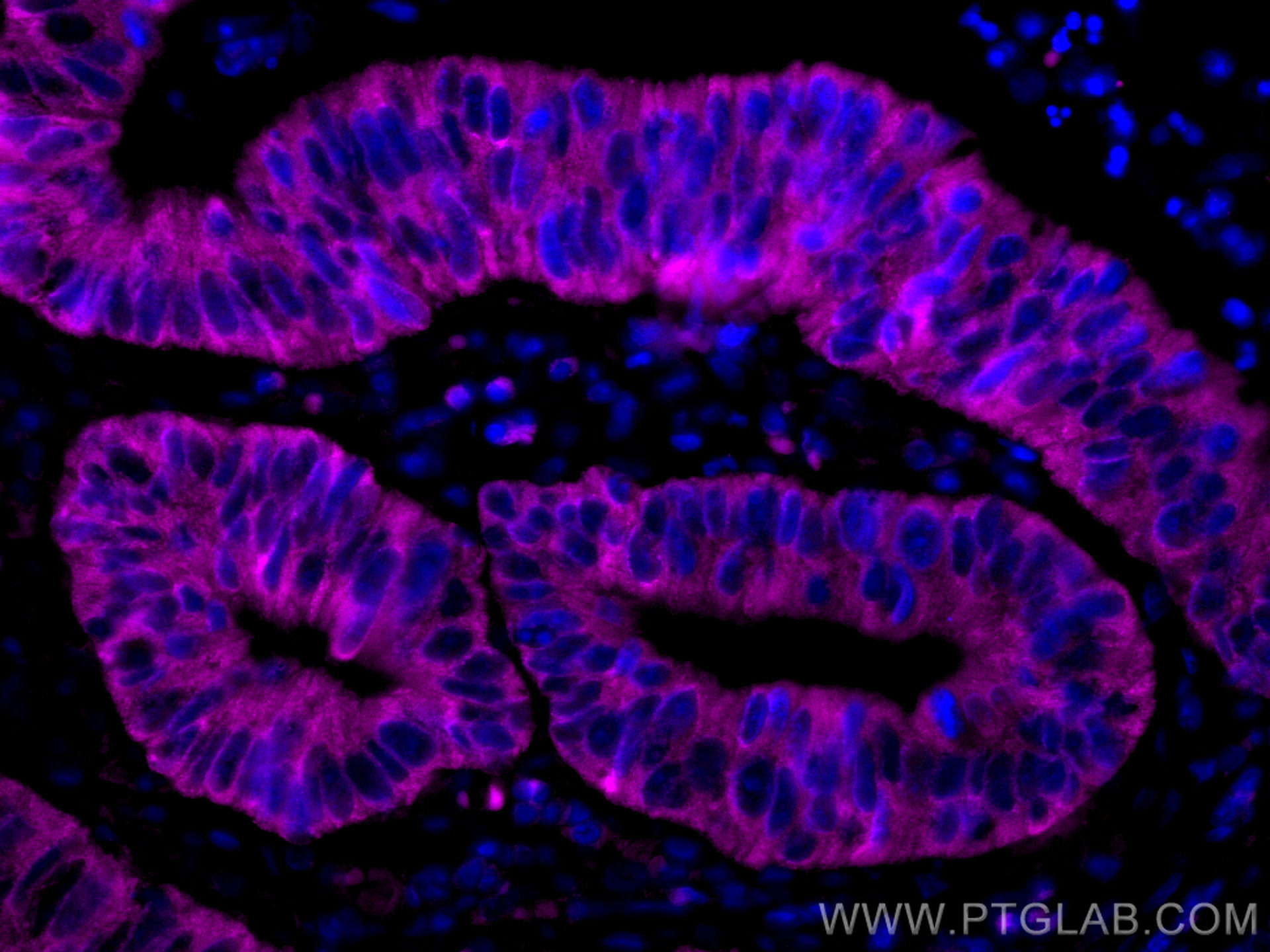 IF Staining of human colon cancer using CL647-16036