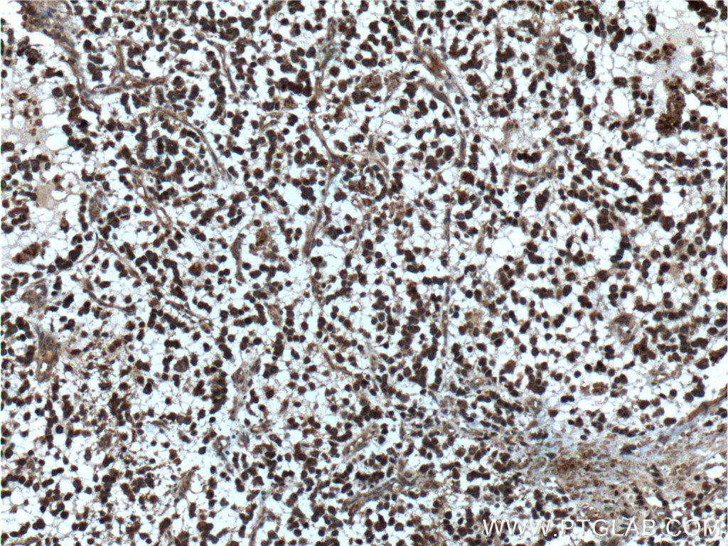 IHC staining of human gliomas using 25524-1-AP