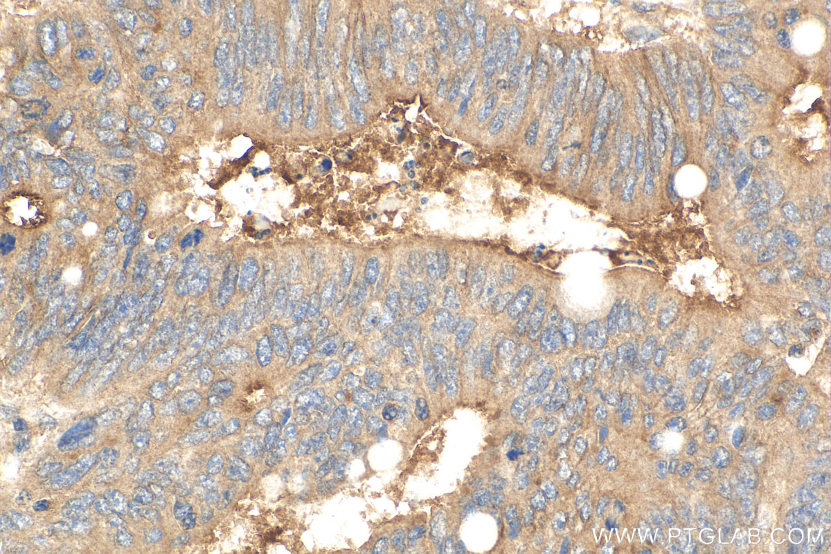IHC staining of human colon cancer using 27093-1-AP