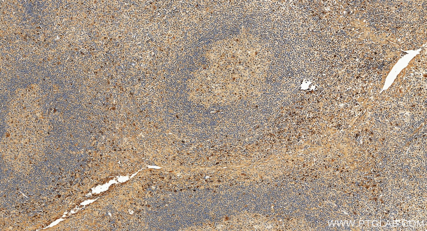 IHC staining of human tonsillitis using 34707-1-AP