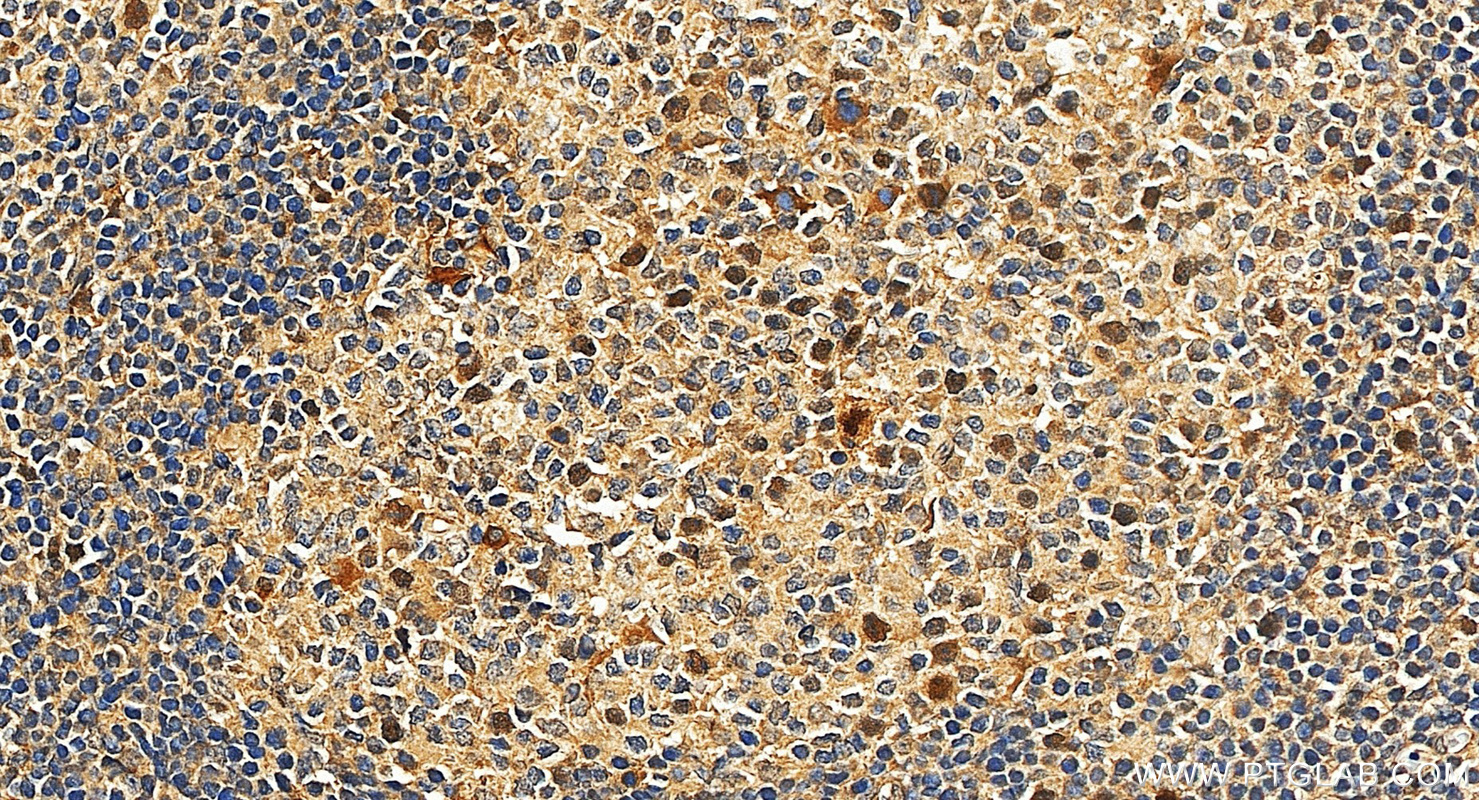 IHC staining of human tonsillitis using 34707-1-AP